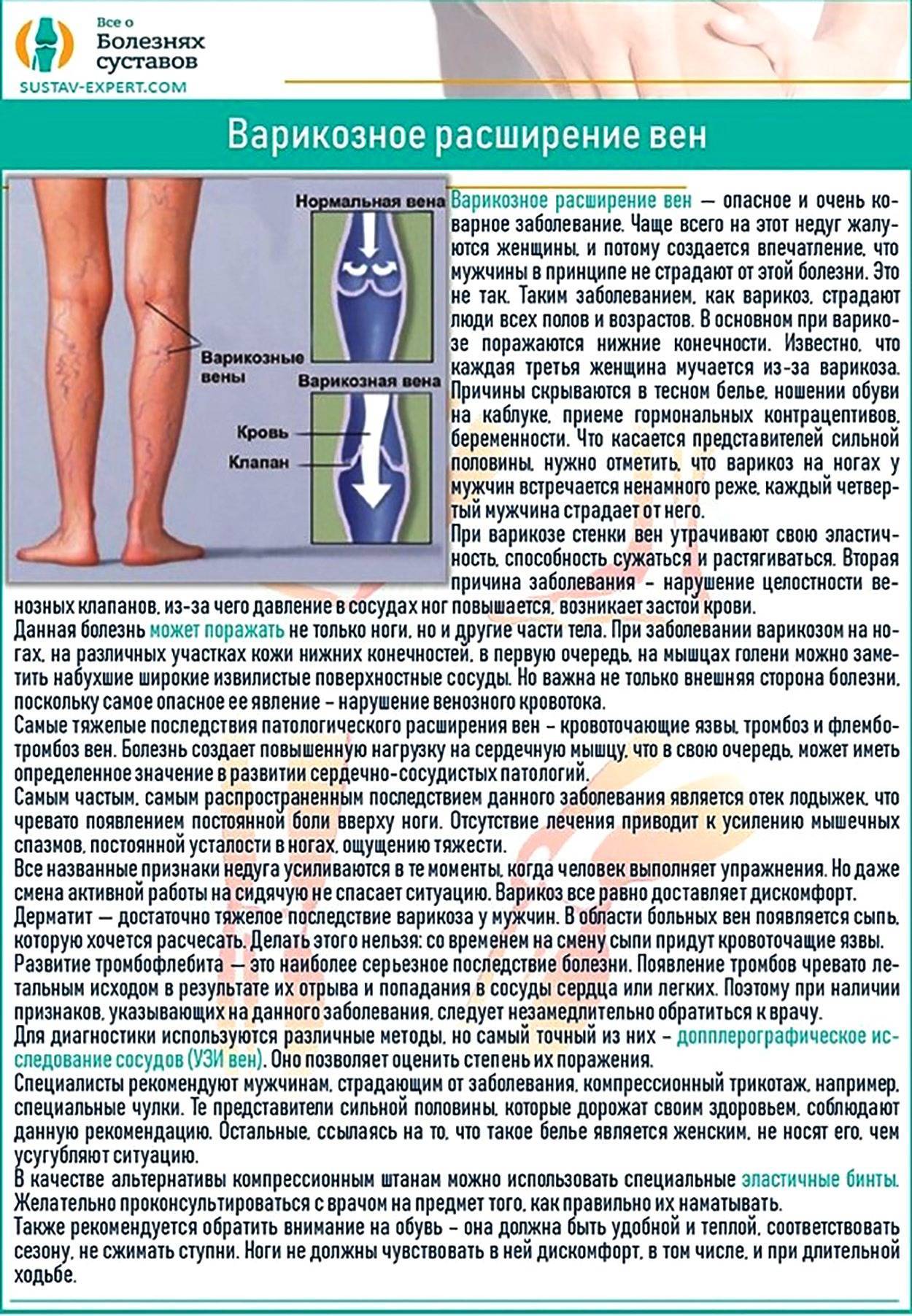 Какие упражнения нельзя делать при варикозе ног, а какие будут полезны? - tony.ru