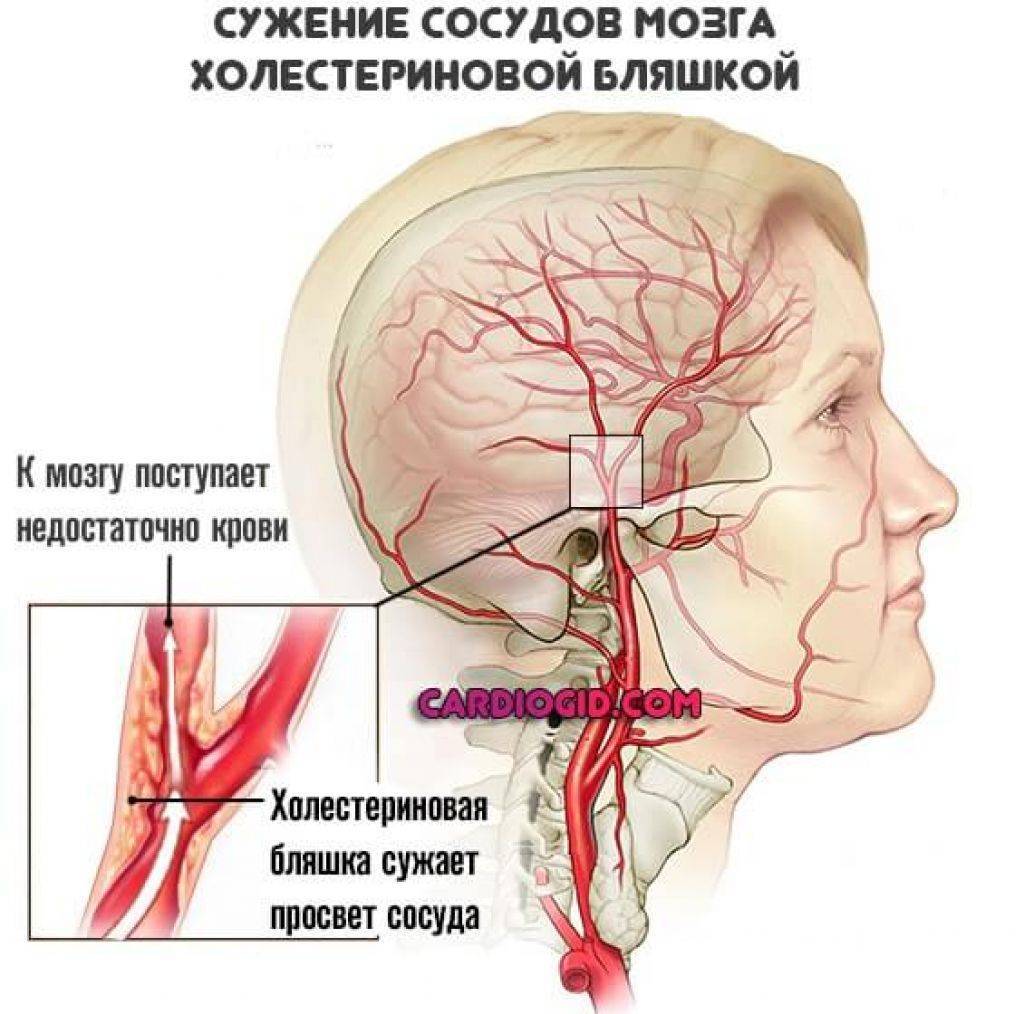Нарушение венозного оттока головного мозга: симптомы и лечение