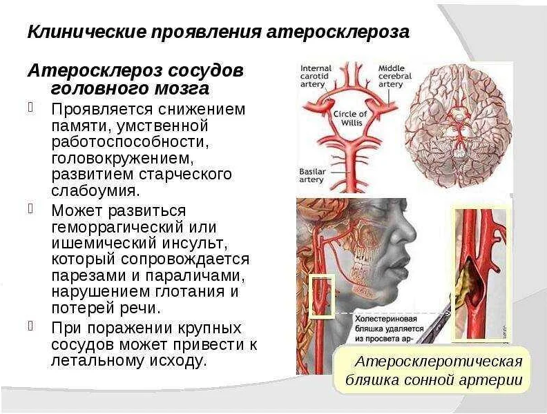Атеросклероз головного мозга – симптомы  и лечение в фнкц фмба россии