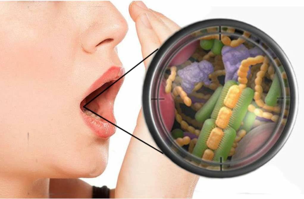 Неприятный запах изо рта (галитоз) — причины возникновения, диагностика и лечение