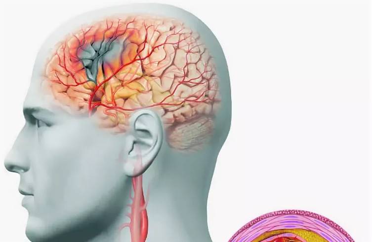 Симптомы и эффективное лечение нарушения венозного оттока в сосудах головы